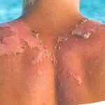 Coup de soleil HVL