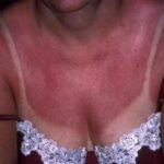 Coup de soleil poitrine
