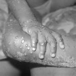 Monkeypox