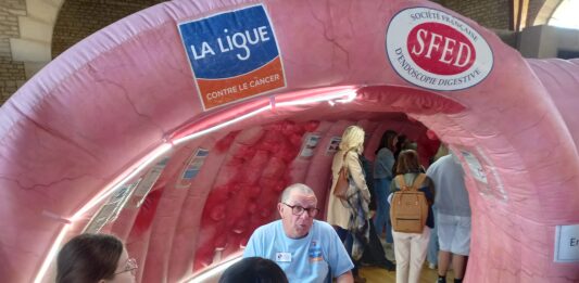 un côlon géant a fait halte à Dole